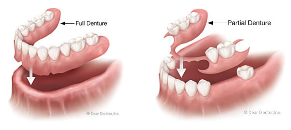 dentures2 - Starbrite Dental - Brampton