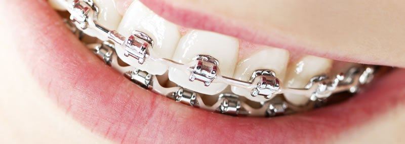 Braces - Brampton Dentist, Bramalea, Caledon, Bolton, Starbrite Dental