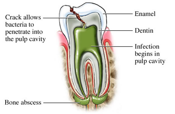 root canal - Starbrite Dental - Brampton