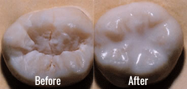 Dental Sealants - Starbrite Dental - Brampton